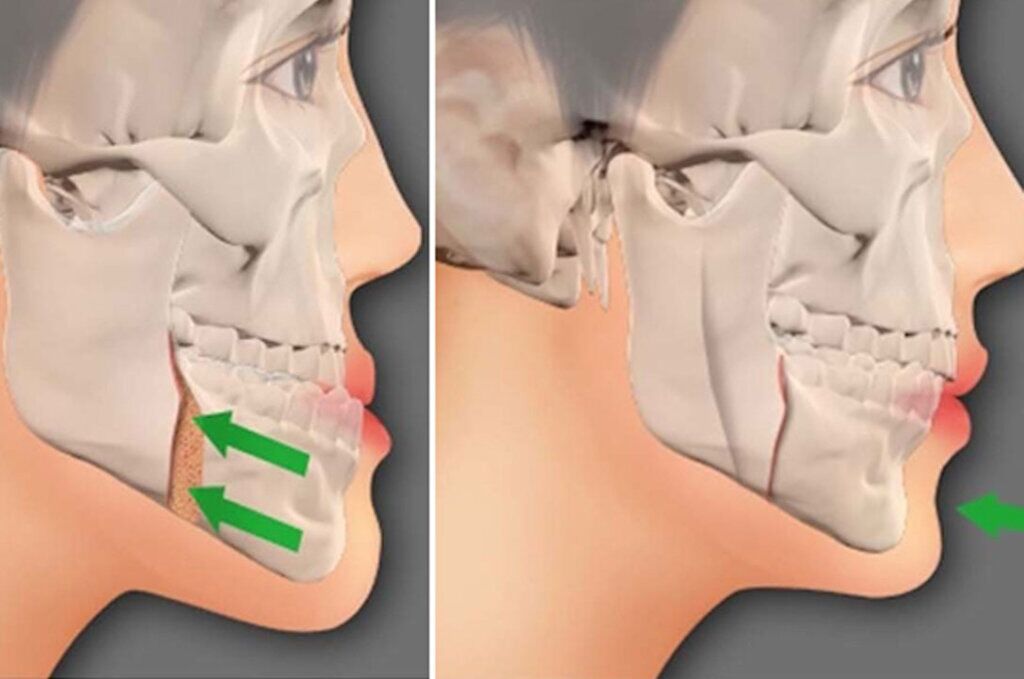 Cirurgia Ortognática - Instituto Maxilo Facial